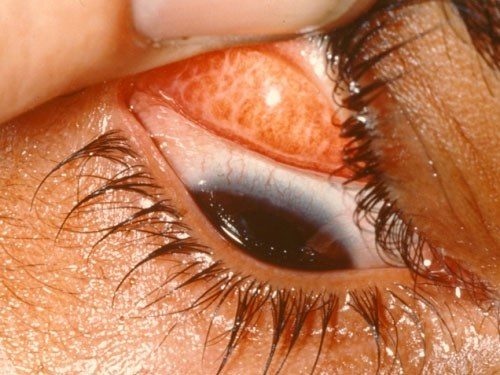 Đau Mắt Hột Nguyên nhân, triệu chứng và cách giảm đau